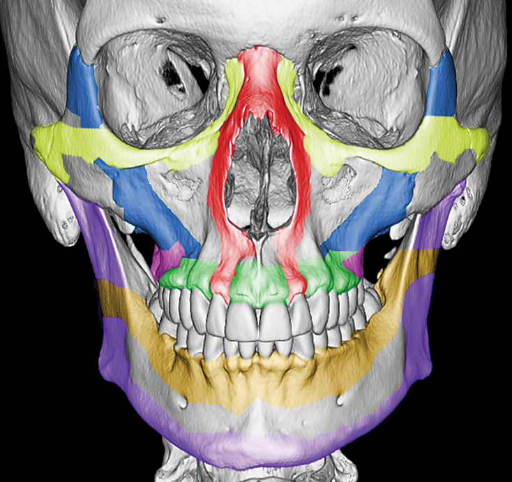 Spectrum of Critical Imaging Findings in Complex Facial Skeletal Trauma
